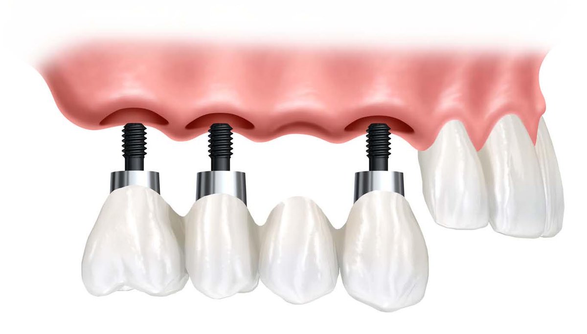 CEIO_Centros's tweet photo. Consejos postoperatorios para que las molestias en implantes dentales sean transitorias y la experiencia sea buena 👍 https://t.co/c2tdKs713n https://t.co/zzUzeD64gM