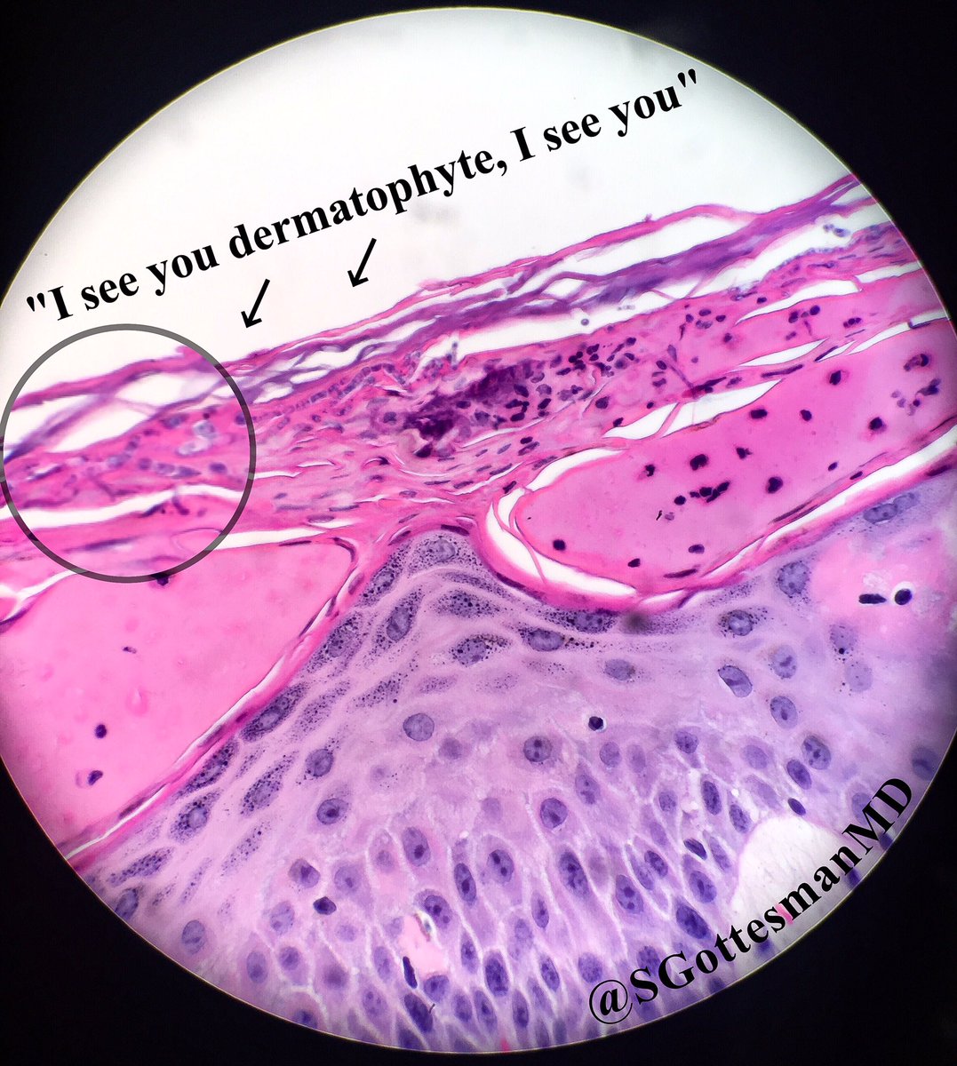 #Dermatophyte infection. Tinea corporis. T. rubrum most commonly.  Histo: "sandwich" sign described by Dr. Gottlieb in 1986 #dermpath