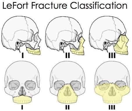 lefort fracture