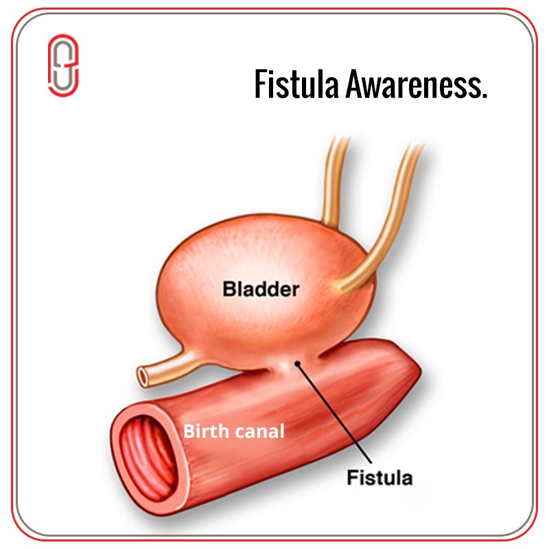 Fistula is a hole between the birth canal and bladder or rectum caused by prolonged, obstructed labour without treatment #fistulaawareness