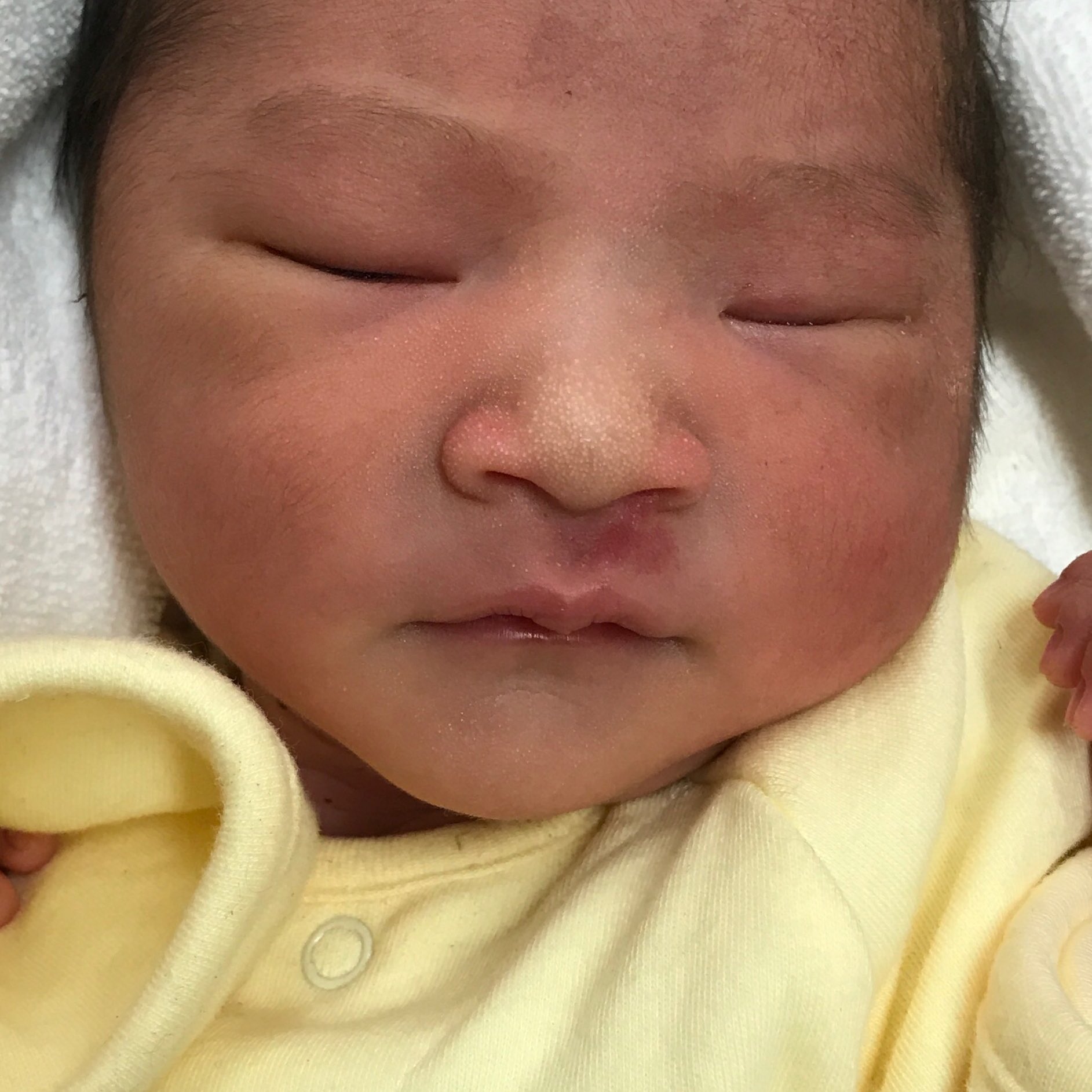 ひまわりママ 0m17d 1枚目今日 2枚目出生当日 生まれて初めて顔を見たときから気になってる 鼻の下の赤あざ サーモンパッチなのか単純性血管腫なのか ネットでいっぱい調べちゃう 薄くなった気もするけど 自然に消えるのかな 病院で相談しても様子