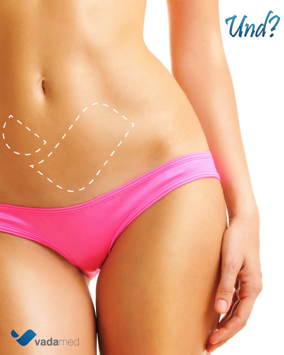 #Bauchdeckenstraffung ▶ instagram.com/p/BUy0VJtADMf/ Klicke auf den Link&amp;trete mit uns in Kontakt #tummytuck #abdominalplasty #vaserlipo #vadamed