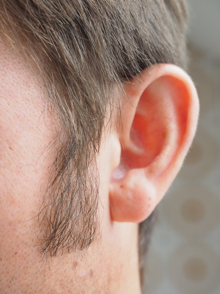 LifeAfterMold's tweet photo. #Irondeficency #anemia increases risk of #hearingloss by 250% https://t.co/Rg5ecSXOxT #hearingaids #tinnitus #sensoryhearingloss https://t.co/y38q2pfnTA