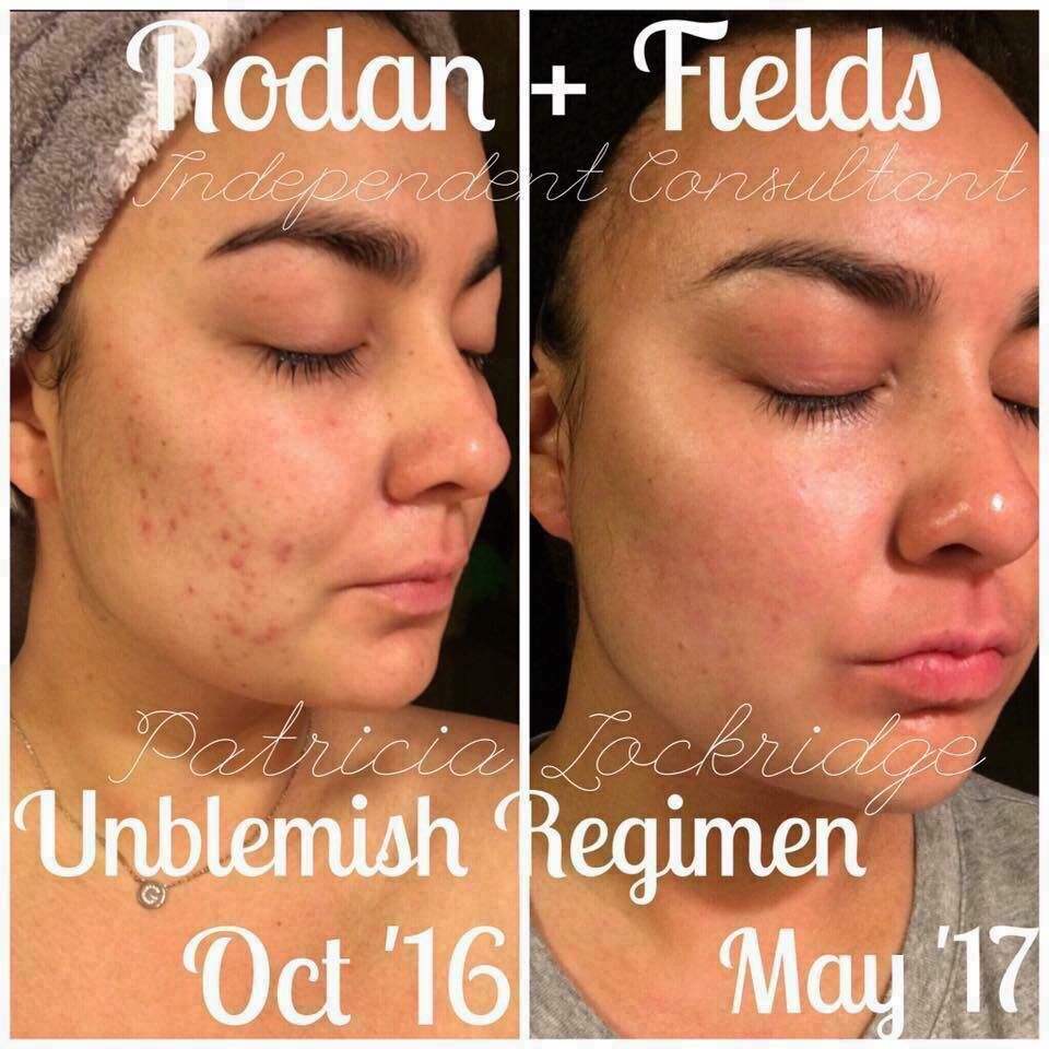 hoosiershell's tweet photo. This. UNBLEMISH has my heart. π Free your skin and gain your confidence!
#controlyouracne #reduceyourpain #loseyourcoverup https://t.co/MRDuJEEYrD