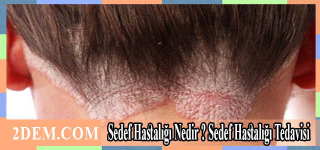 Sedef Hastalığı Nedir ? ... ve #SedefHastalığıNasılGeçer #SedefHastalığıNeIyiGelir tüm bilgiler için tıklayınız 2dem.com/2017/06/sedef-…