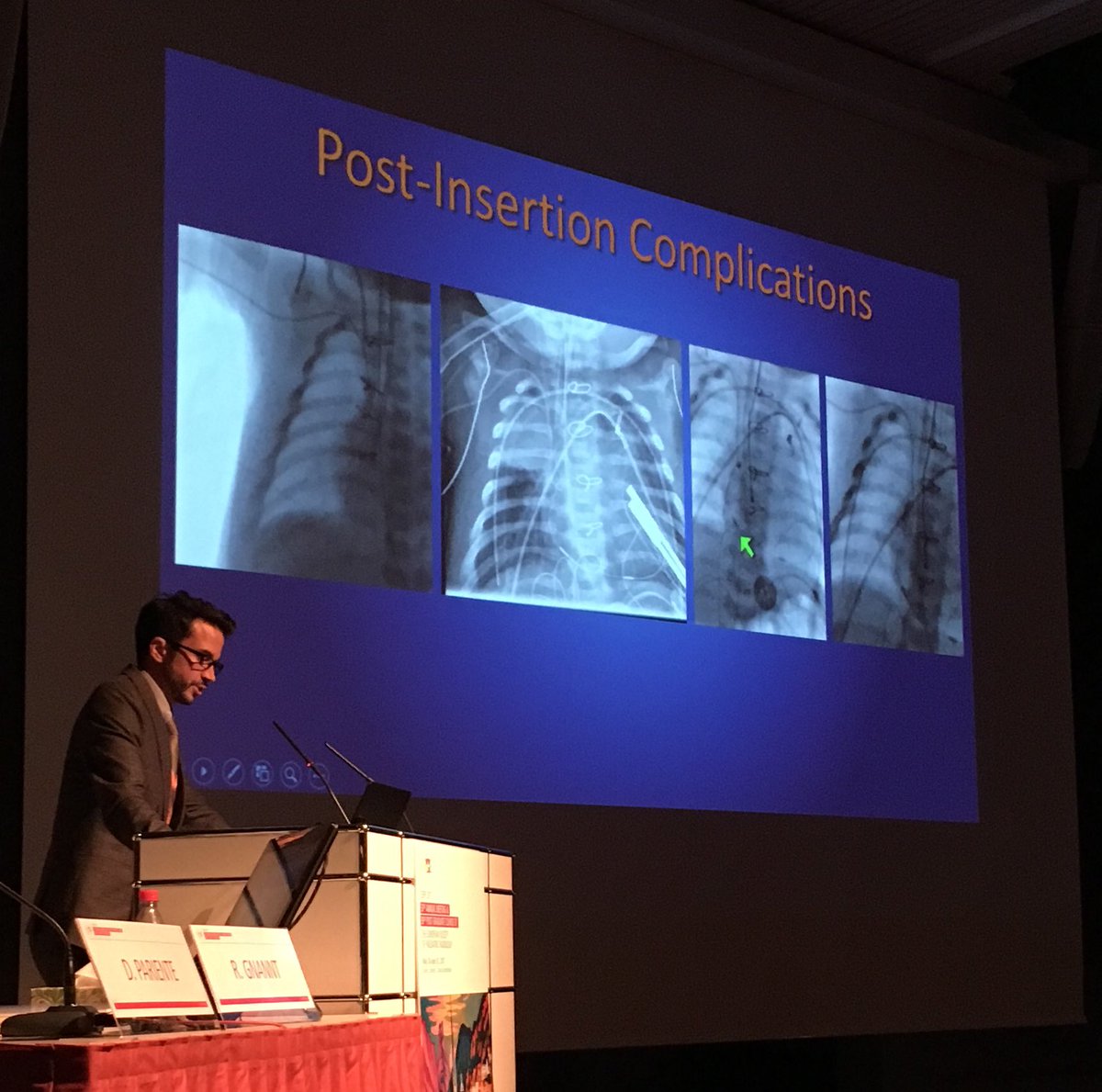 Premal__Patel's tweet photo. At #ESPR2017 @gnannt #PedsIR from #KinderspitalZurich shows why #IRad should manage #Pediatric central #vascularaccess #withoutascalpel https://t.co/izvx9HaYnU