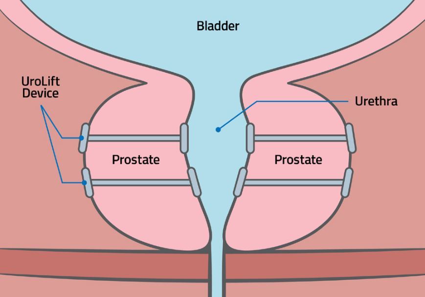 What is the female version of a prostate