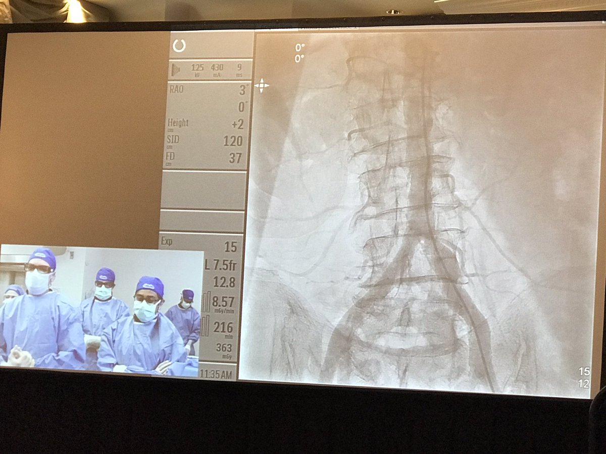 KhandelwalMD's tweet image. Live #Transcaval #TAVR by @AdamGreenbaumMD @BillONeillMD Dr. Guy Paone and Dr. Marvin Eng @HenryFordNews #DetroitPCI17