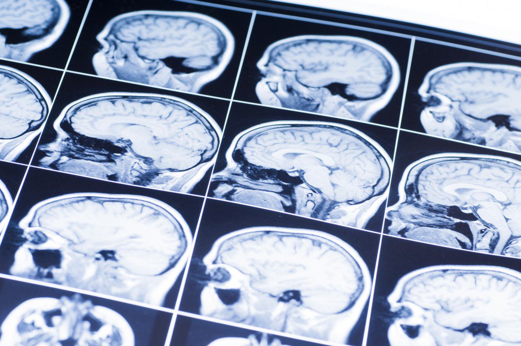 RandyRozek's tweet photo. Imaging library for traumatic brain injury underway - https://t.co/LtsBaLKaO0 #braininjury #tbi https://t.co/URPcToGefh