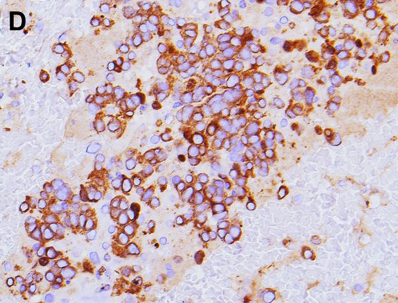 CancerCytopath's tweet photo. Review. Algorithmic approach to neuroendocrine tumors in targeted biopsies: Practical applications of IHC markers https://t.co/L5Uz3tZToi https://t.co/4Y8zJwc0di