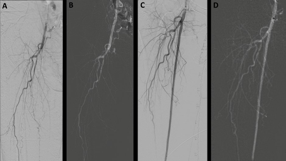 alankoay81's tweet photo. 1st in Msia to use CO2 #DigitalSubtractionAngiography (26/5/2017). Comparison btw #ICM & #CO2 for ATK & BTK vessels @DocKumara @johanrizwal https://t.co/xGDRhmFOit
