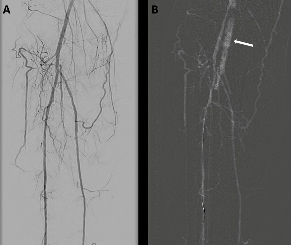 alankoay81's tweet photo. 1st in Msia to use CO2 #DigitalSubtractionAngiography (26/5/2017). Comparison btw #ICM & #CO2 for ATK & BTK vessels @DocKumara @johanrizwal https://t.co/xGDRhmFOit
