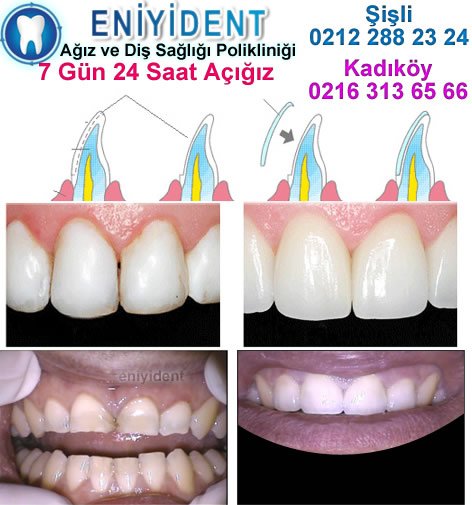 En Etkili Diş Tedavi ... ve #LamineDişNasılYapılır #LamineDişYaptıranlarınYorumları tüm bilgiler için tıklayınız uzmandisdoktoru.net/en-etkili-dis-…