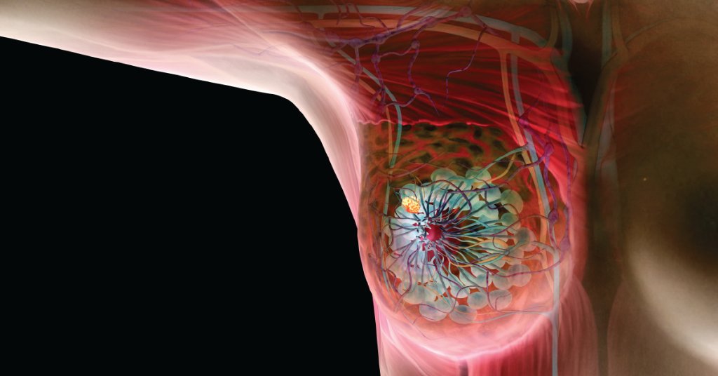 Breast cancer often has no symptoms, but there are few things you may notice that you'll want a doctor to check out. wb.md/2seZstk