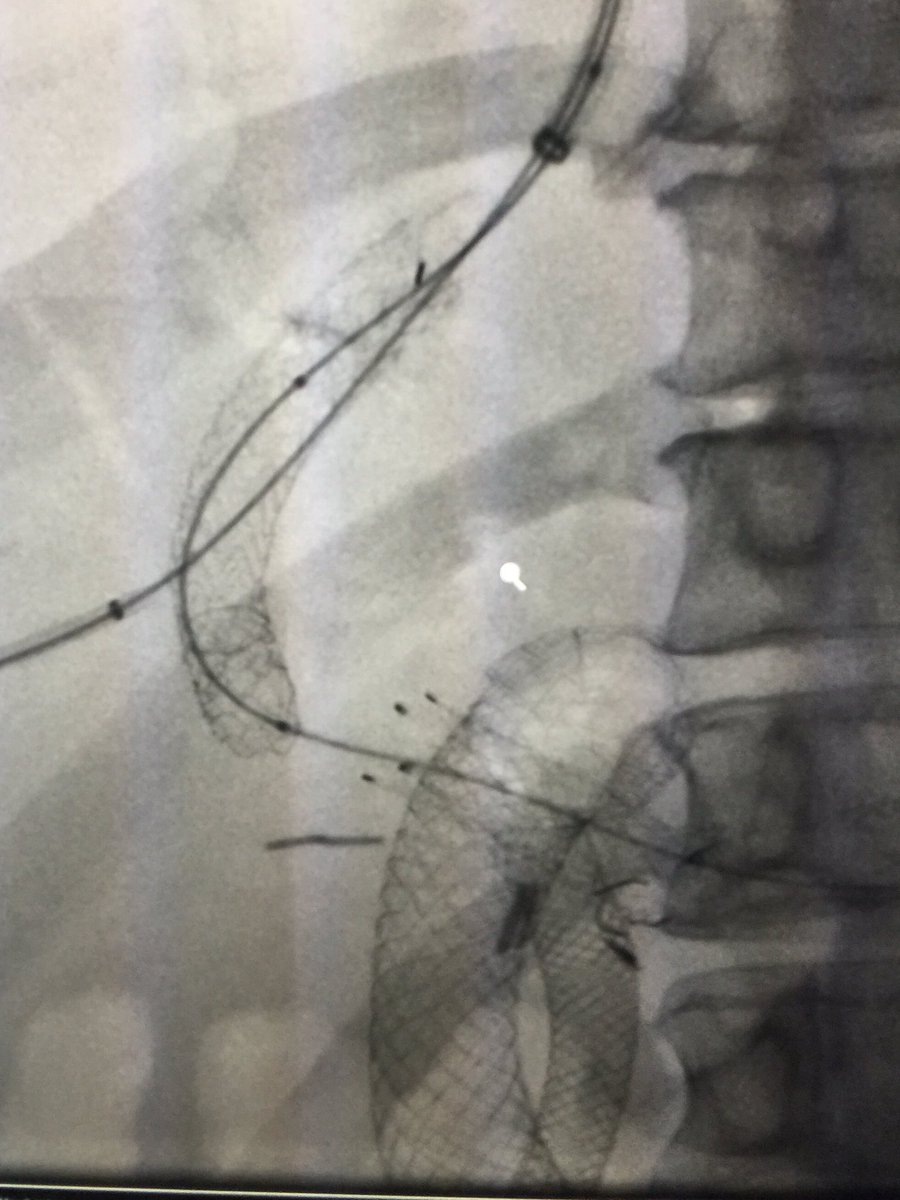 ClintWrigley's tweet photo. Occluded TIPS requiring percutaneous transhepatic access to revise.  #miip #irad #SMHCS https://t.co/clhpVnJoZB