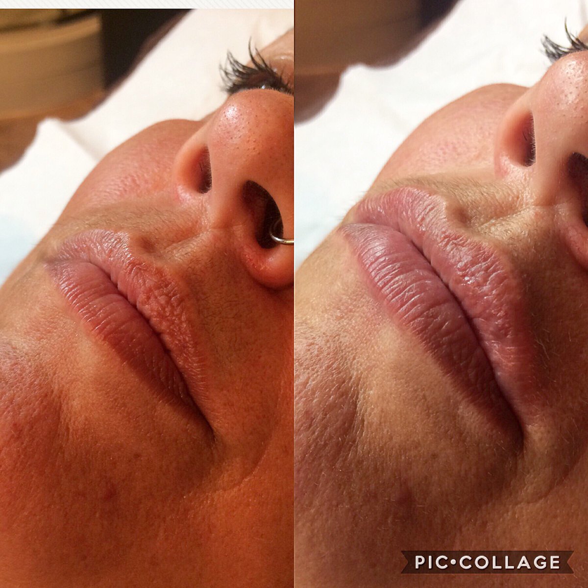ChloeDaveySPMU's tweet photo. Soft Gel Dermal Lip Fillers- 1ML- Chloe Davey Aesthetics 💉💋 #lipfiller #facialaesthetics #dermalfiller #pout https://t.co/HOHvlWsAMK