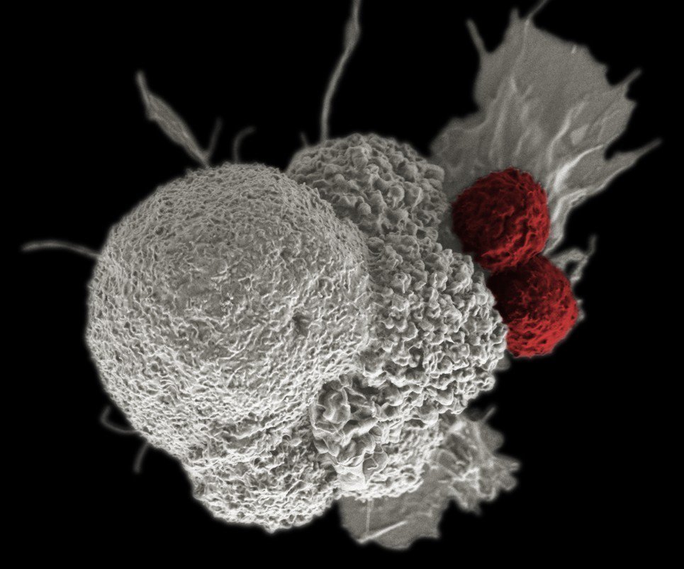 theNCI's tweet photo. What does cancer look like up close? If you are at #ASCO17 please check out our images: https://t.co/FVUXzzJ1tM #cancercloseup https://t.co/D1NZLUMxUU