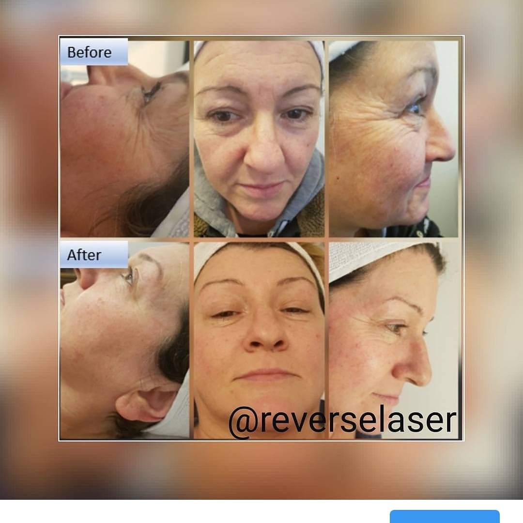 reverselaser's tweet photo. #carbonlaserfacial before and after pics after recommended block of 6 facials 😘 https://t.co/MpzwmuRFDs