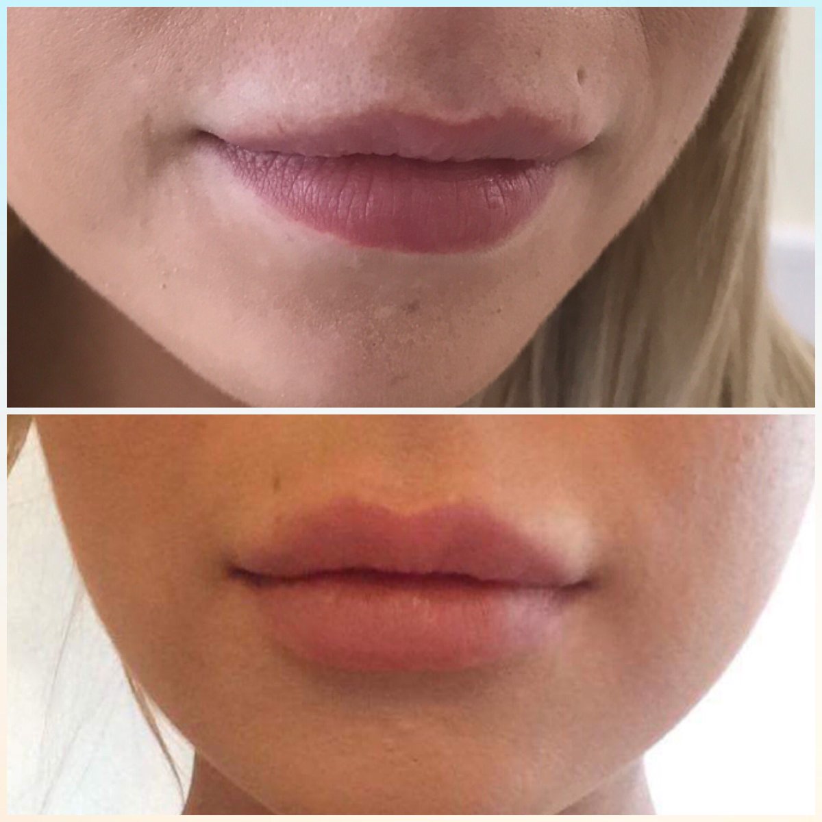 catrin121's tweet photo. Beautifully soft enhancement with 1ml juvederm volbella. #drcatrinwilliamsaesthetics #volbella #juvederm #lips #northwales https://t.co/BmxqhuAIC3