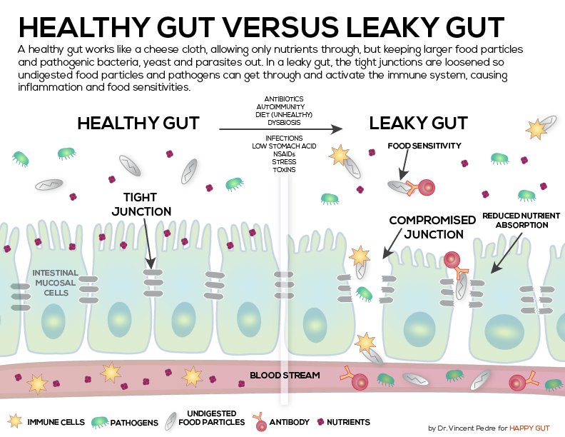 KraftChiro's tweet photo. Leaky Gut is not any fun. It leads to a conventional medicine catch-all diagnosis of "Fibromyalgia" Learn more at: https://t.co/fIb5QZem6O https://t.co/GfQ85oF7dd