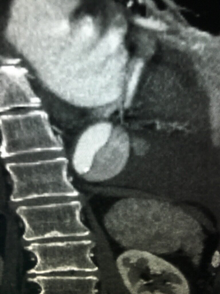 kevinsealsmd's tweet image. Note this case of poke-ball ingestion #abrcore #coreprep