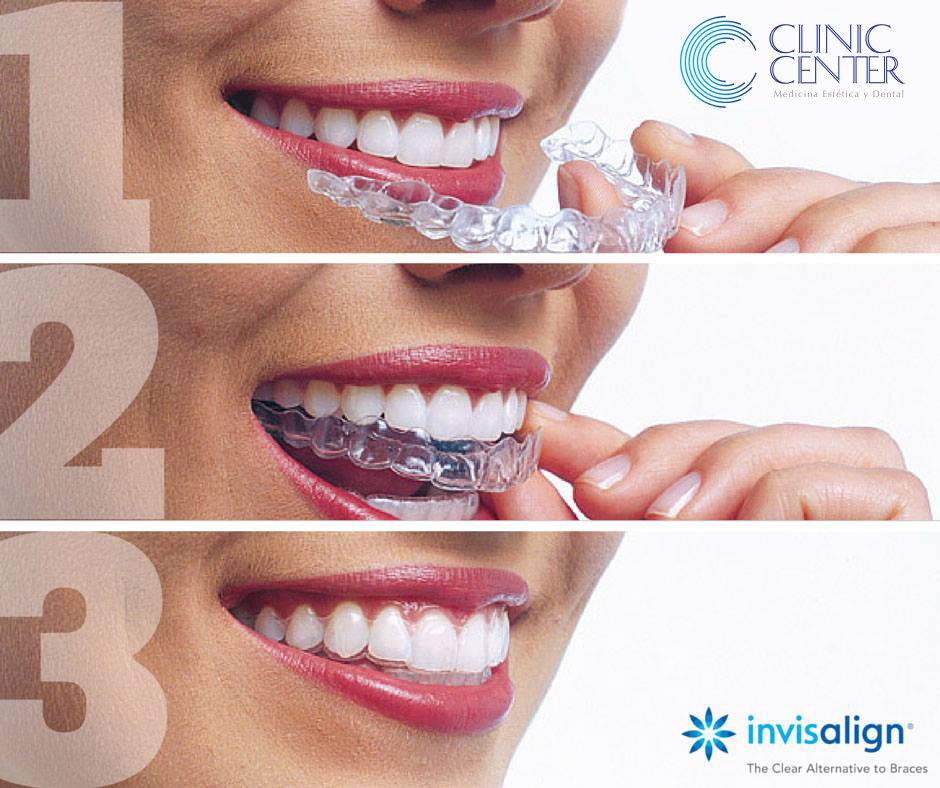 ClinicCenterBCN's tweet photo. 3 pasos que tendrás que hacer si quieres alinear tus dientes y que nadie te lo note. ¡Ni tu mismo!

☎937 825 465 - 684 306 440 https://t.co/hl4vnzSUwF