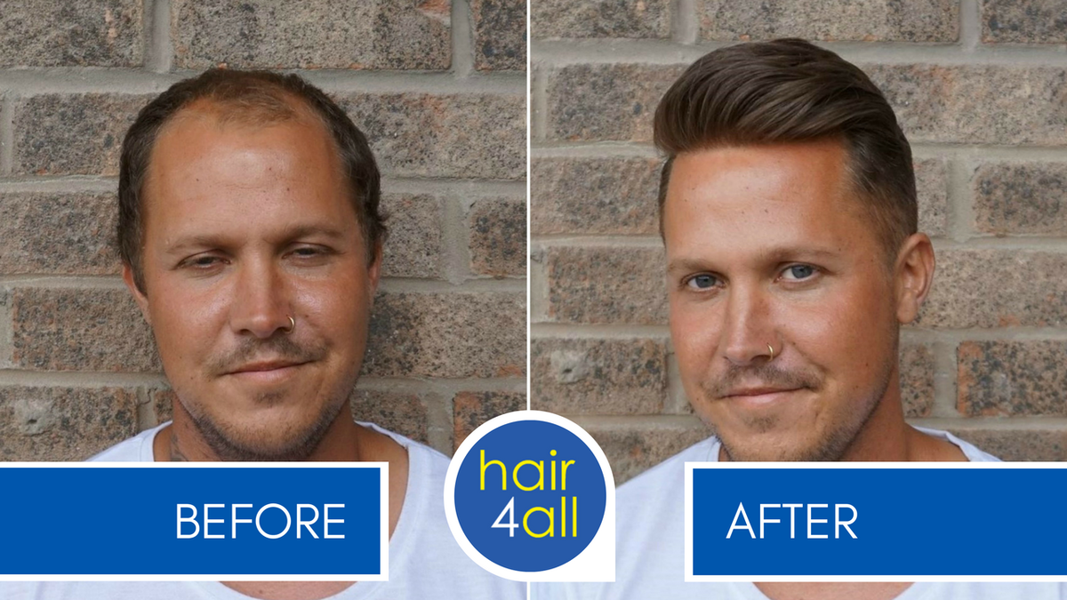Hair4all On Twitter Before After A Non Surgical Hair