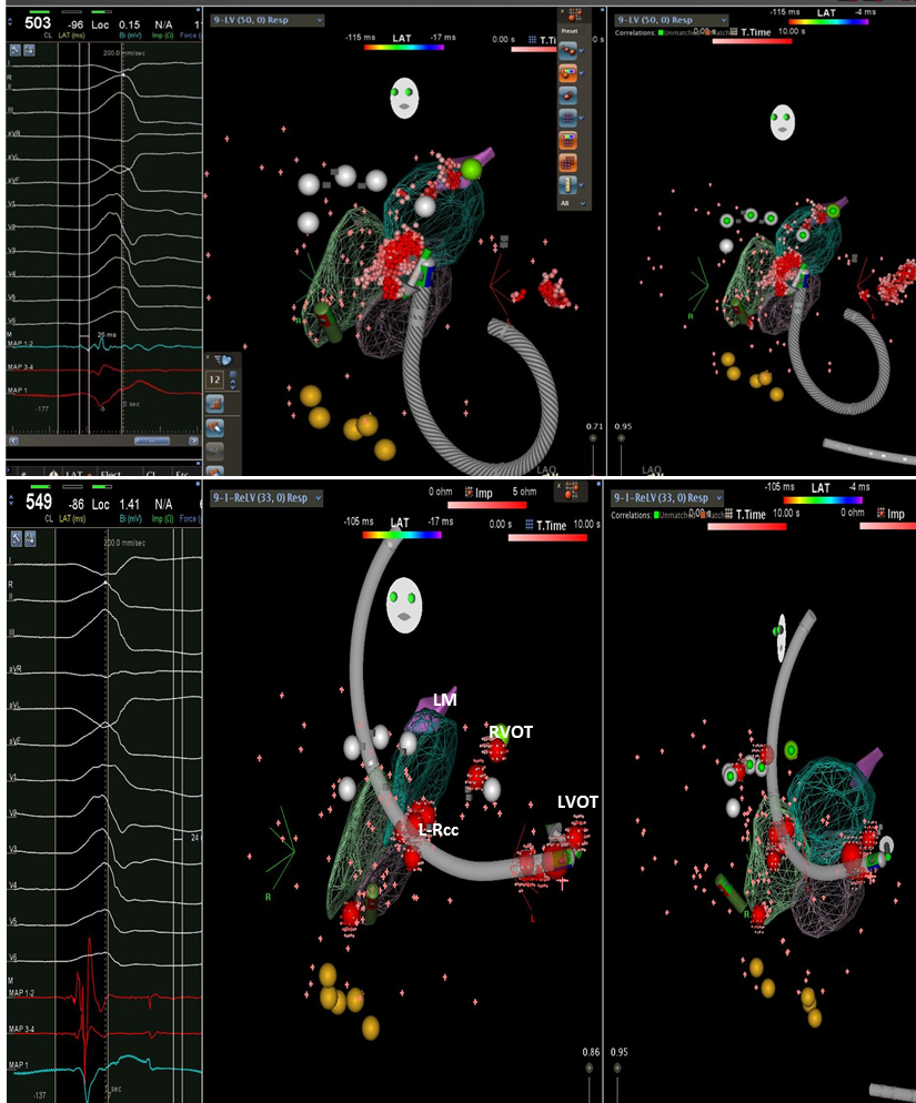 Intramural LV summit PVC ablated successfully by targeting multiple adjacent sites