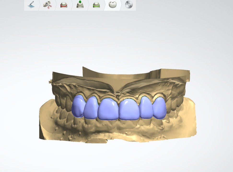 ChrisC4mpbell's tweet photo. Another anterior job. Slowly getting there but still work to do @DentalLogicEdin on the @3Shape software https://t.co/cifErG83L4