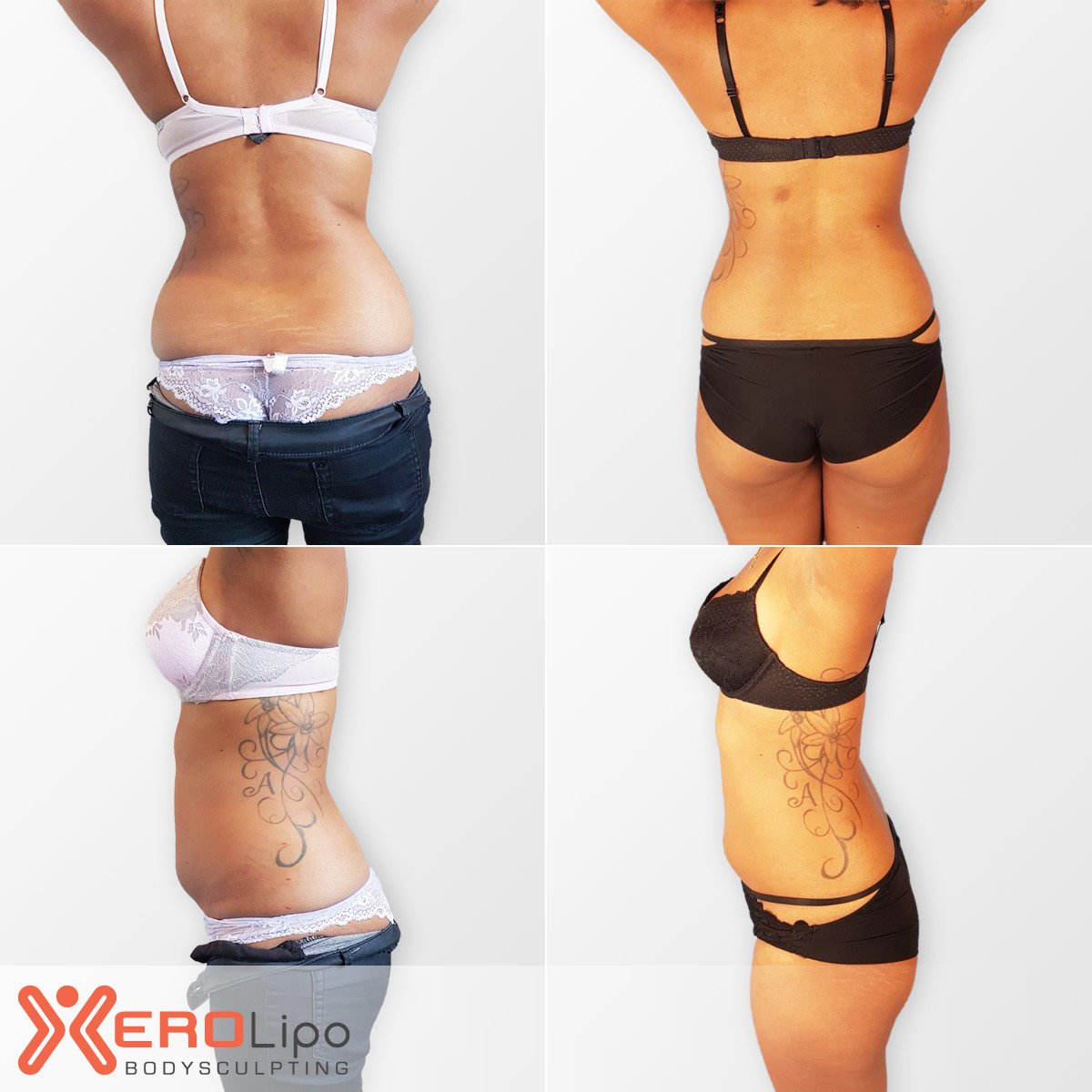 XeroLipo's tweet photo. #results that speak for themselves! #laserlipo #xerolipo #bodyshaping #bodysculpting #bodycontouring #beauty #aesthetics #fatreduction https://t.co/QTkfsXaIBv