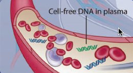 AlexSilverMSTP's tweet image. Be cautious in diagnosis of #cancer from #cellfreeDNA, per #ASCO17 abstract: #clonalhematopoiesis also makes #cfDNA! ow.ly/XUqi30cmTSP