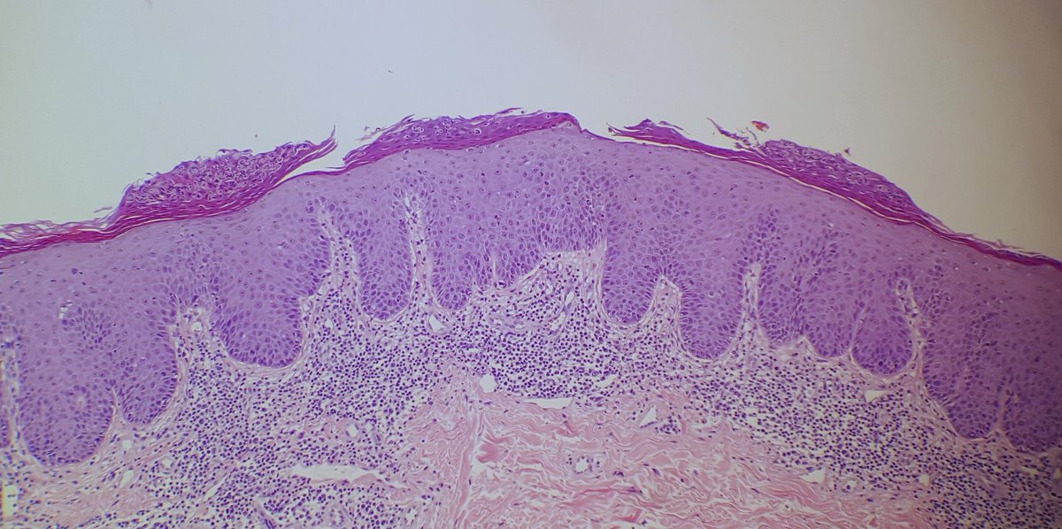A psoriasiform-lichenoid pattern is a clue to MF, syphilis or TNF-i drug reaction. This case is MF. #dermpath #pathology #dermatology