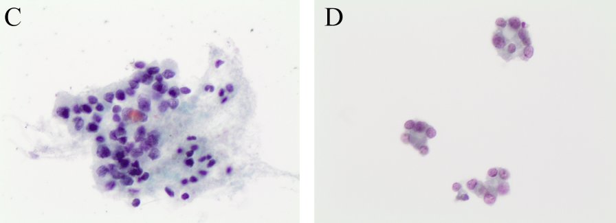 CancerCytopath's tweet photo. New! The role of #thyroid FNA cytology in pediatric malignant lesions: An overview of the literature https://t.co/gFlAtzvZQ5 https://t.co/TBn9WBc3jE