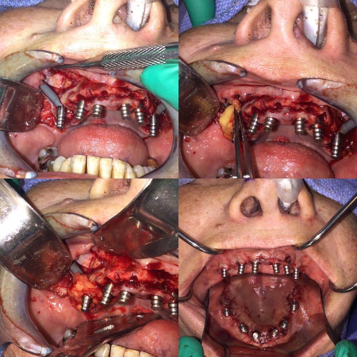kirkpatrick68's tweet photo. Well hello there buccal fat pad. #beautiful #closure #surgery #therealfacedoc #noworries #bone #implants #zygomas #oralsurgery #florida https://t.co/kmqk0L1nvo