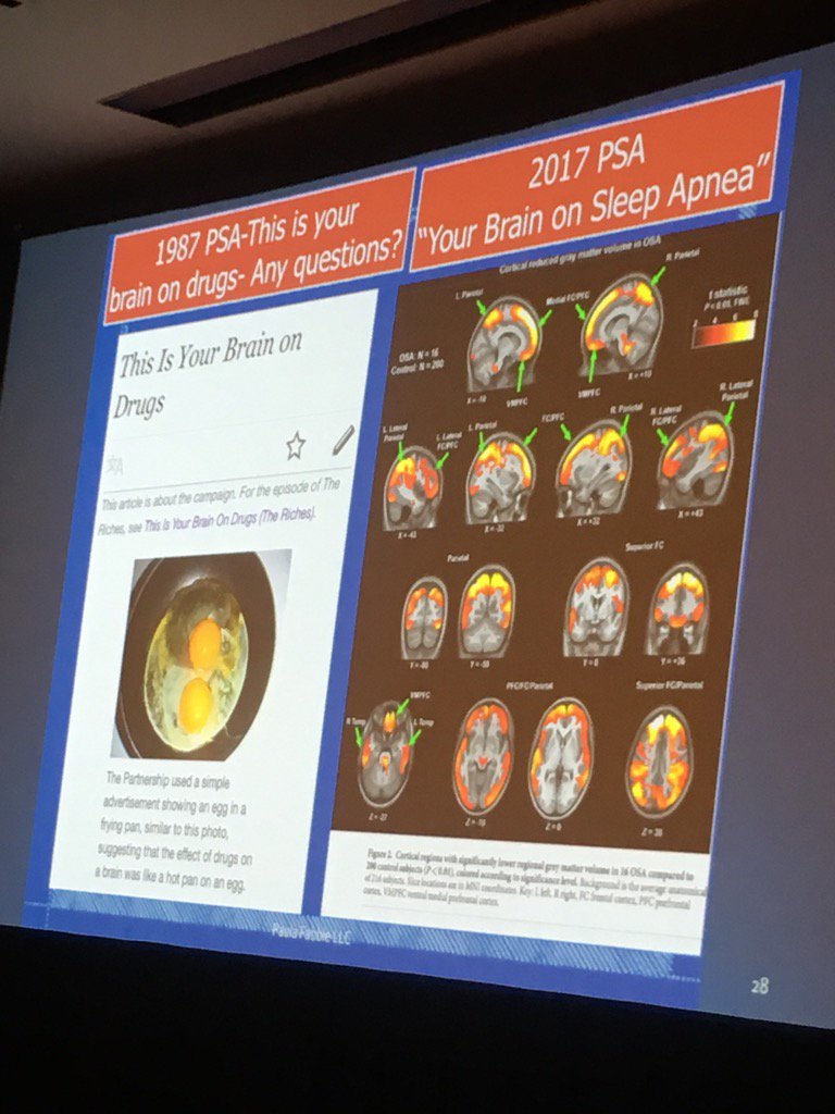 Fabbie: "Your Brain on Sleep Apnea" #sleep #sleepapnea #mouthbreathing #snoring #TOTs2017