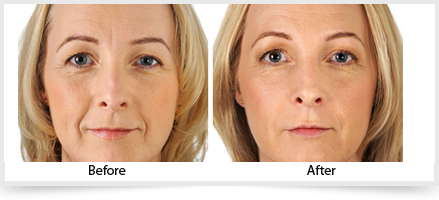 Know More about #DermalFillers – #Wrinkle and File Lines Treatment It's ...