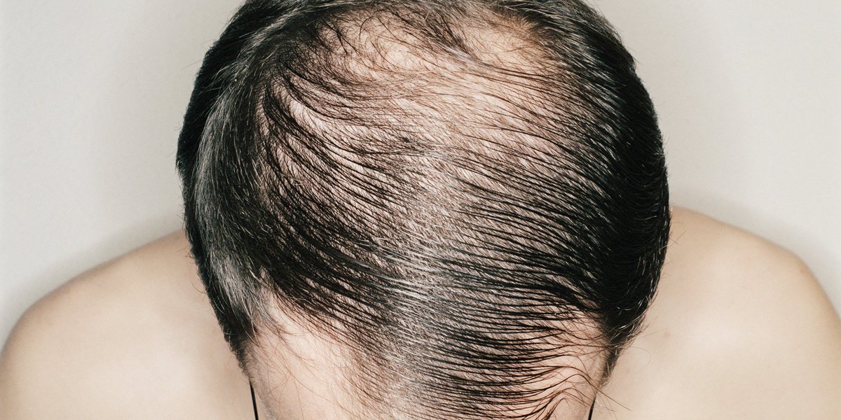 Sahay96Sahay's tweet photo. Read Post If You're a Victim Of Hair Thinning, See How To Cure It.
#hairtransplantationworld #HairLoss 
https://t.co/duczgE4PRu https://t.co/pdXvO6Ywd6