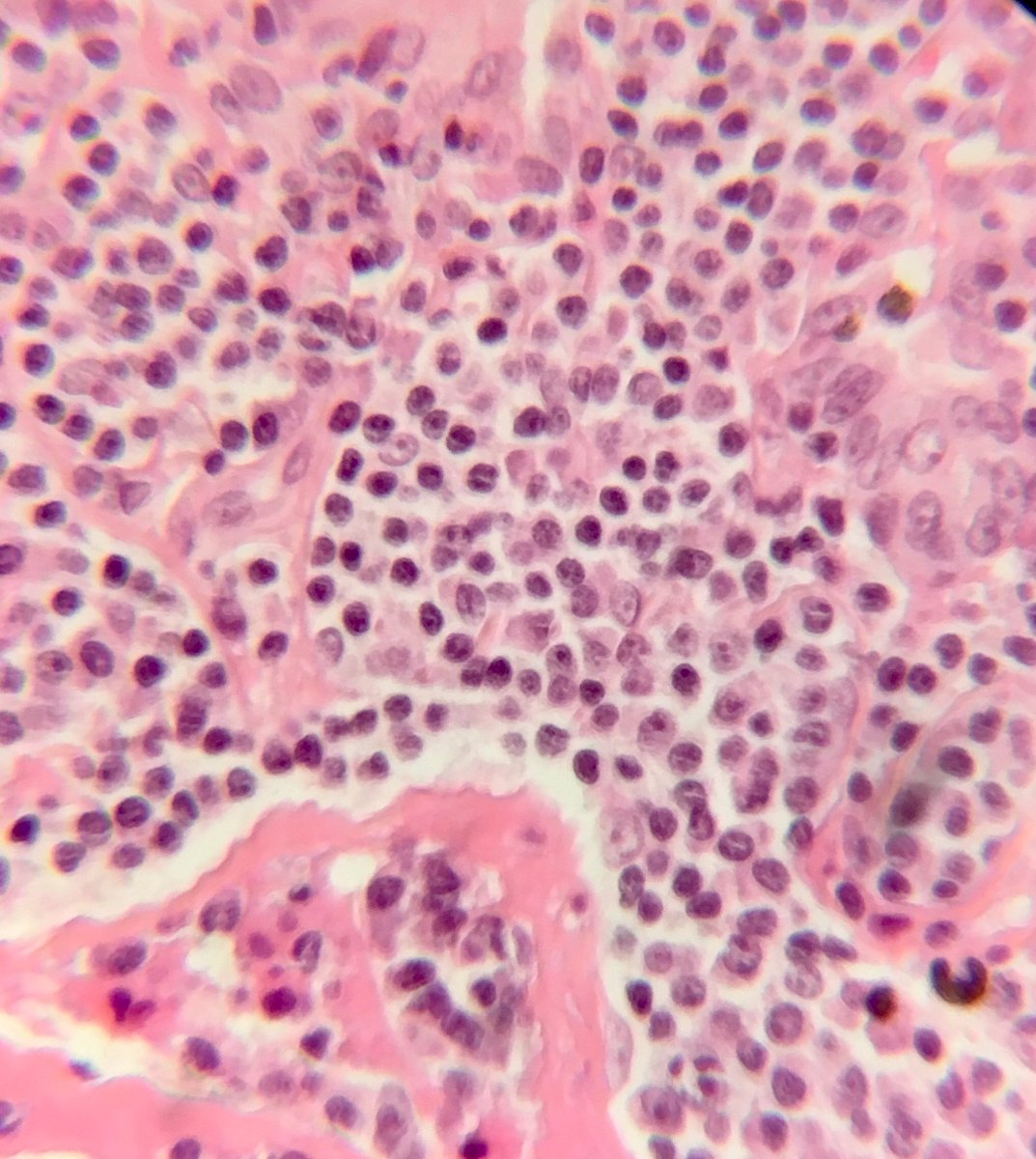 seattlequinns's tweet image. EMZL-MALT lung. Lymphangitic pattern, lymphoepithelial lesions w/ intraluminal plugs, Dutcher bodies. CD43+ t(11:18) in 40%. #pulmonarypath