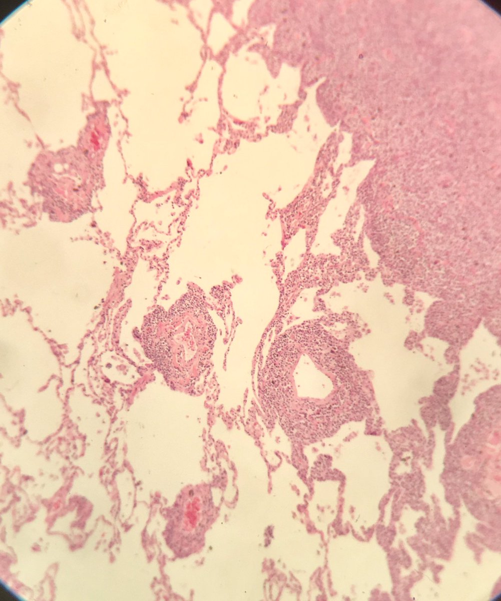 seattlequinns's tweet image. EMZL-MALT lung. Lymphangitic pattern, lymphoepithelial lesions w/ intraluminal plugs, Dutcher bodies. CD43+ t(11:18) in 40%. #pulmonarypath