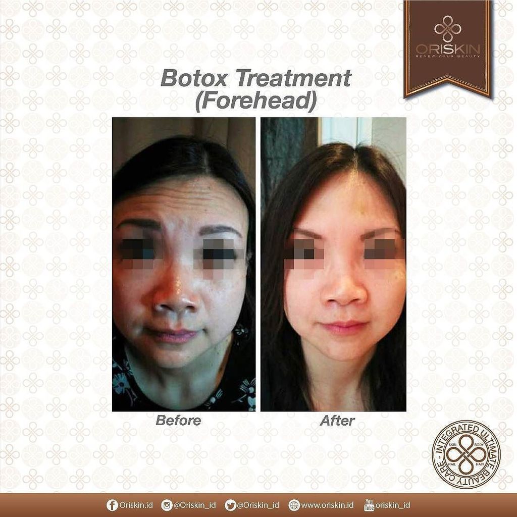 Oriskin_ID's tweet photo. Inner beauty is great, nut a little botox never hurt. Get yours @oriskin_id with free consultation. #oriskinid #or… https://t.co/XQsZ8IxQ0B https://t.co/KYZrjivJLR
