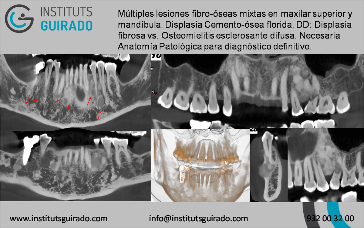 Caso Clínico DD: Displasia fibrosa vs Osteomielitis esclerosante difusa. Dr. A. Florensa. #CBCT #ConeBeam #TC #NewTom5G