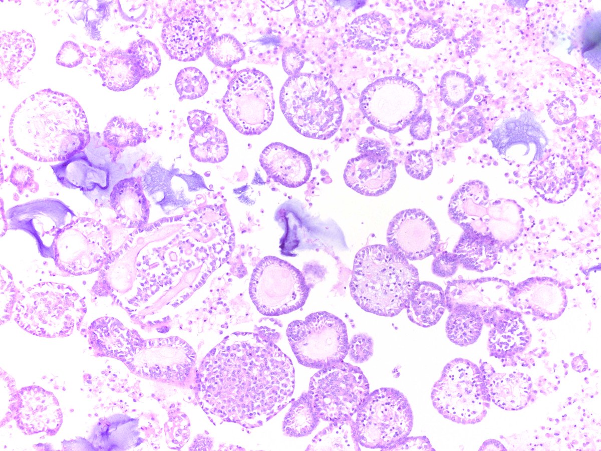 mesothelioma cells