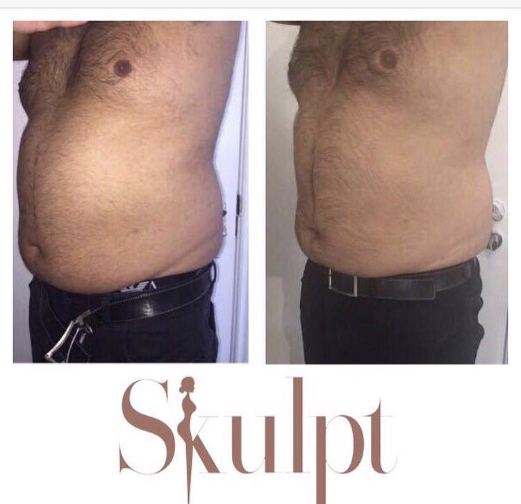 VennHealthcare's tweet photo. 😲😲Before & after 😲😲combination treatment of #CLATUU #fatfreezing followed by #enCurve - @weareskulpt #NonSurgical #FatLoss #InchLoss https://t.co/0NVL6c689I