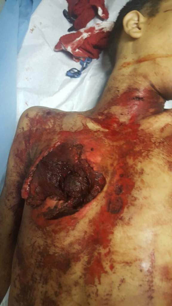 ErikaOSanoja's tweet photo. Fotos atribuidas al joven Neomar Lander. (Atención: gráficas explícitas). Versión opositora: «lacrimógena» Extraoficial: manipulaba mortero. https://t.co/s5udmlzSfP