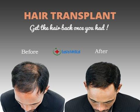 eastamedical's tweet photo. #Korea_Hair_transplant  is a surgical technique to grow hair 
Read more: https://t.co/gLgVIfteIj https://t.co/E2fmUpeMNA