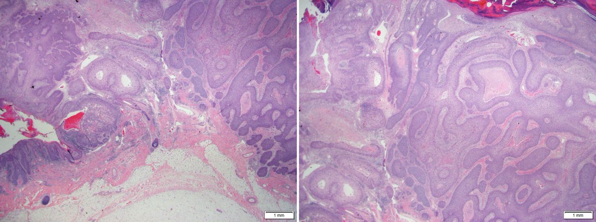 Dermpathl's tweet photo. Bowen's carcinoma (invasive Bowen's disease) is a high-risk variant of cutaneous SCC. Chest 55 y/o M PMID: 16630176 #dermpath https://t.co/e3WMvDBgue