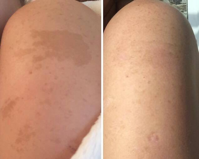 NWWstudios's tweet photo. RESULTS TIME
Amazing after only one treatment for birth mark removal with our revolutionary Pure Skin Touch https://t.co/C1i1e65YBQ