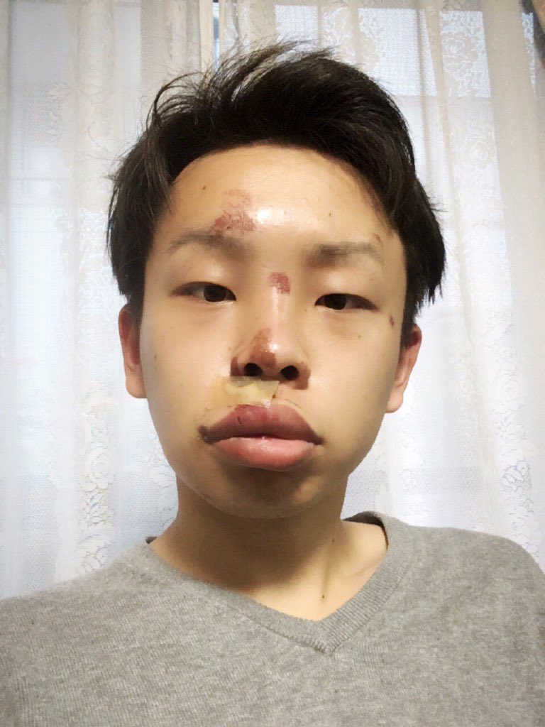 ゆうすけ در توییتر 面白いのは自分じゃなくて事故後の自分のおでんくん顔だけですよ笑