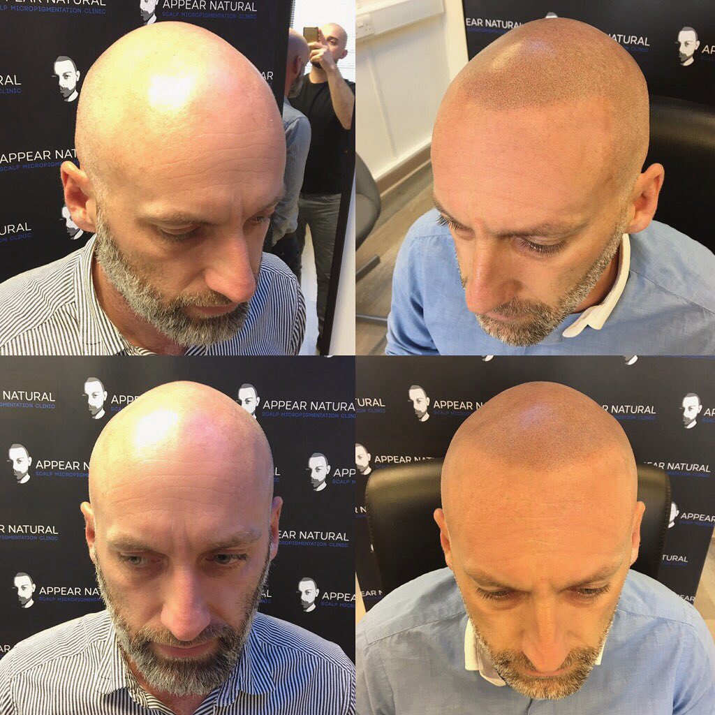 AppearN's tweet photo. Call 0207222338 to find out more about Scalp Micropigmentation!#hairloss @BeckBromFL @bromleyfl @WoW_Bromley @ @Bromley_UK_News https://t.co/X4Zi6xP2CN