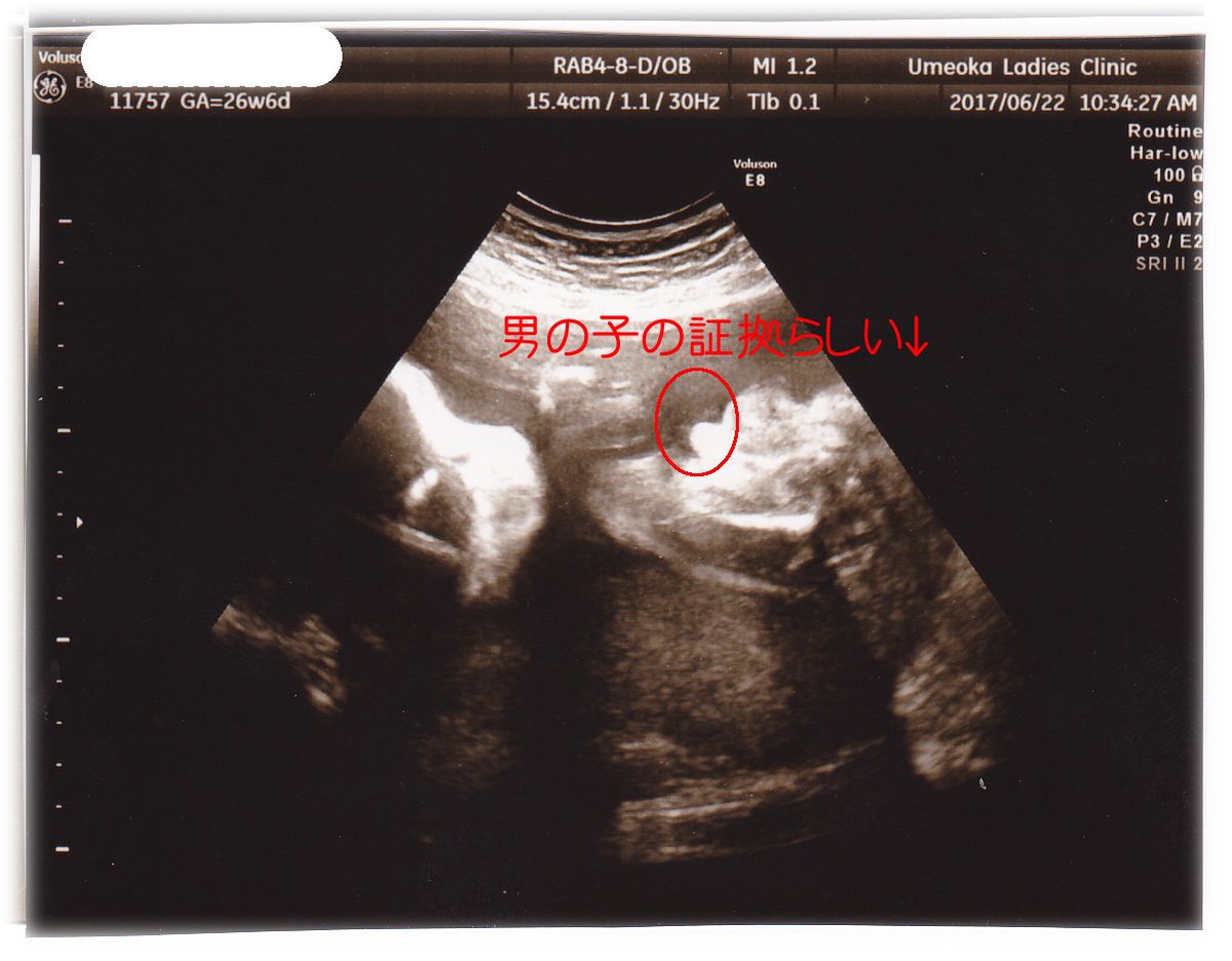 エコー 見方 写真 初期 妊娠